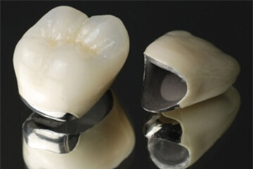 メタルセラミック