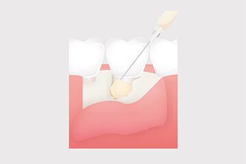 再生療法（エムドゲイン）